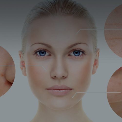 Acne and Acne Scars