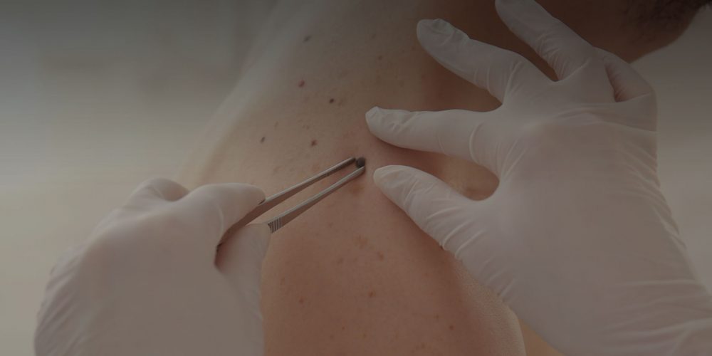 Dermatosurgery