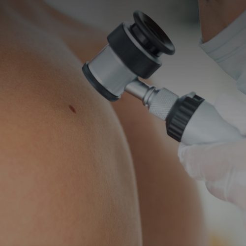 Mole Mapping for Melanoma