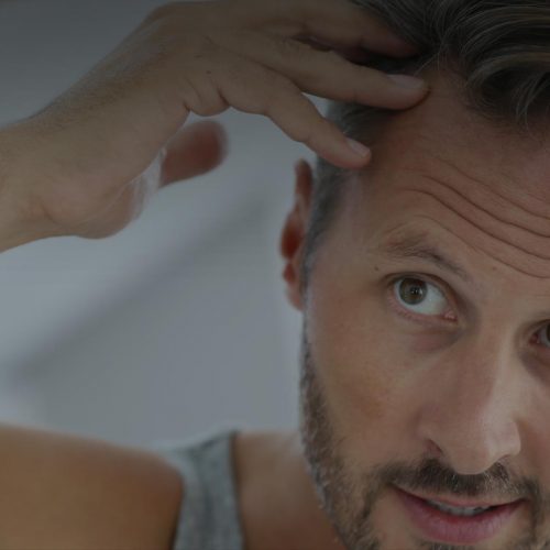 Hair loss / Alopecia