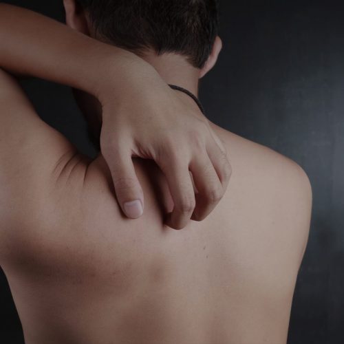 Psoriasis Treatments