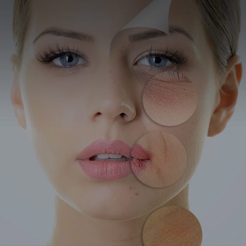 Skin Peels