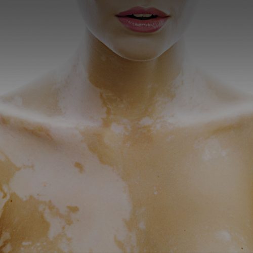 Vitiligo Treatments