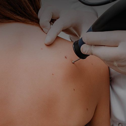 Wart / Mole / Skin Tag Removal