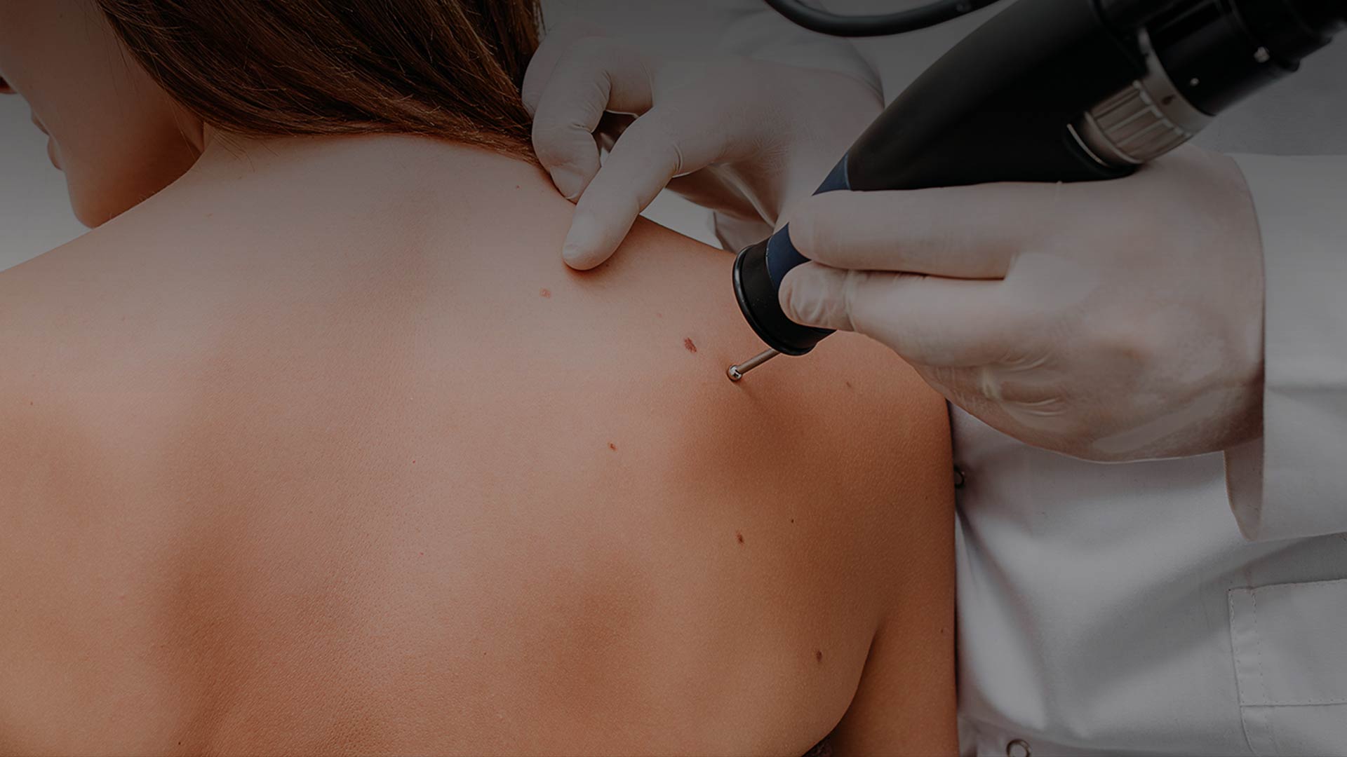 Wart / Mole / Skin Tag Removal | Umhlanga & Ballito, Durban | Dr Ishaan ...