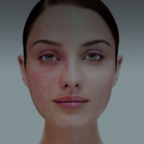Redness and Rosacea