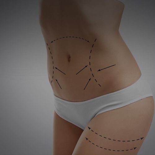 Scar Therapy / Stretch Marks